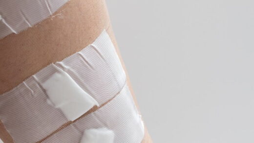 leczenie żylaków nóg